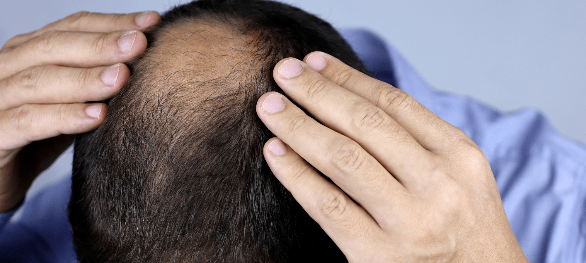 hair loss can effect anyone